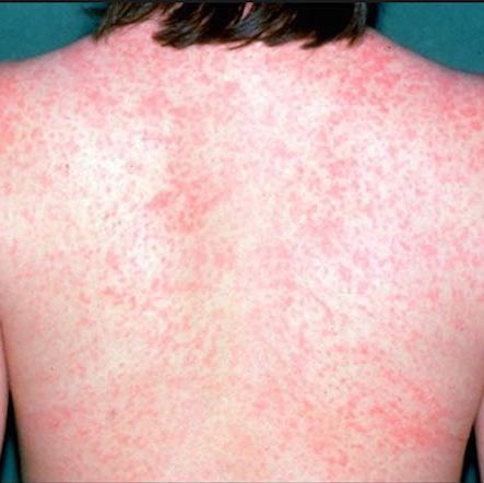 Think it’s measles? Phone first before visiting your GP - Nelson ...